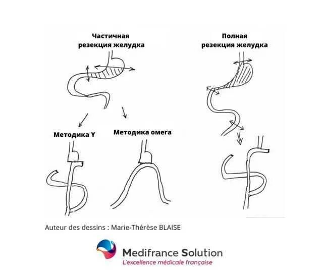 После удаления части желудка. Полная резекция желудка при онкологии. Продольная резекция желудка (ПРЖ). "Частичная резекция" желудка схема. Удаление желудка операция.