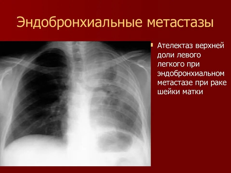 Рак нижней доли. Ателектаз верхней доли правого легкого на рентгене. Ателектаз верхней доли слева рентген. Ателектаз доли рентген. Ателектаз верхней доли рентгенограмма.