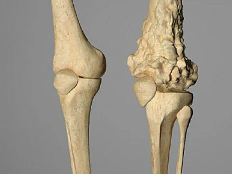 Опухоли костей и мягких тканей. Остеогенная саркома бедренной кости рентген. Злокачественная опухоль кости рентген. Опухоль юинга бедренной кости. Хондробластическая остеосаркома.