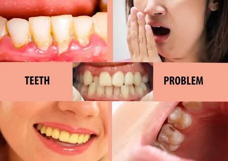 दांतों की बीमारी, कारण व इलाज Teeth Problem in Hindi