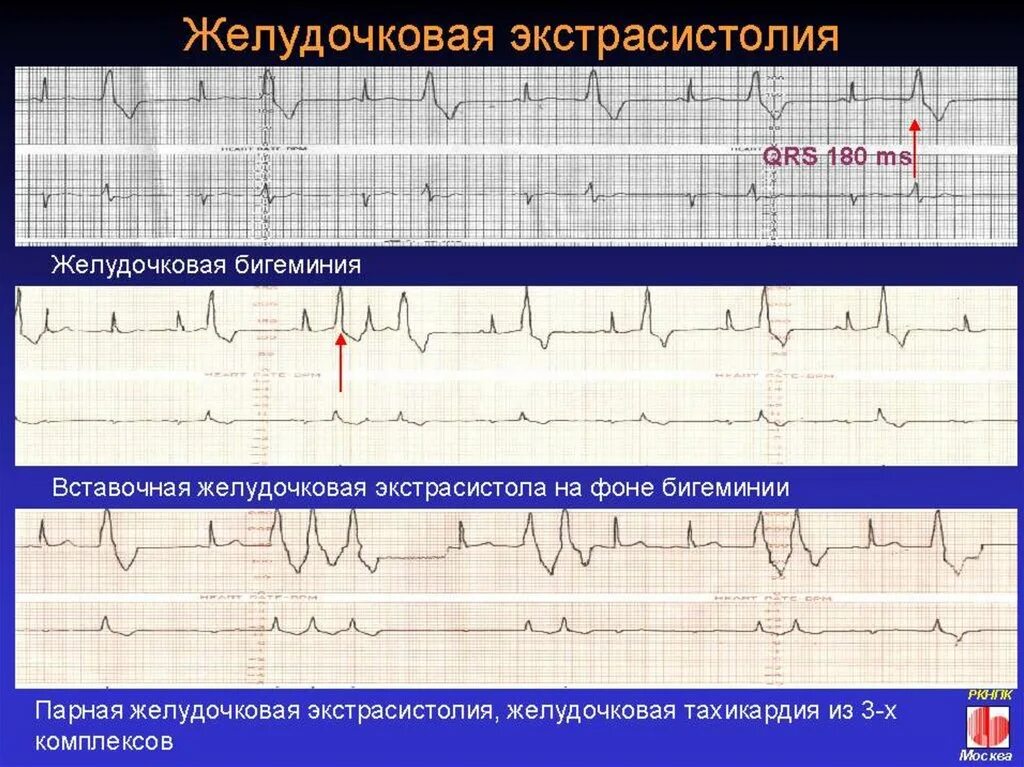 Желудочковая бигеминия на ЭКГ. Экстрасистолия по типу бигеминии ЭКГ. Экстрасистолия бигеминия ЭКГ. Желудочковая экстрасистолия на ЭКГ. Типы желудочковых экстрасистол