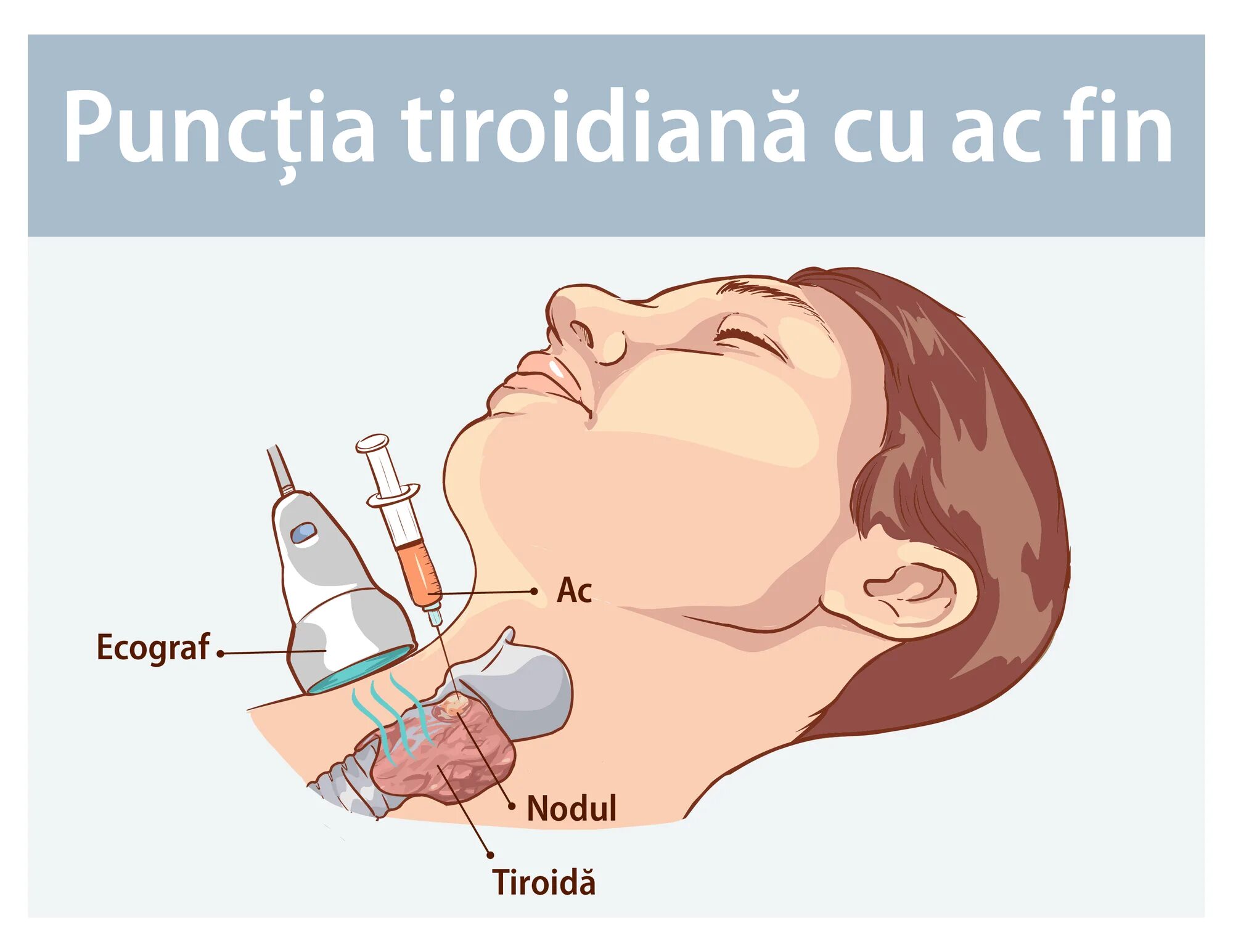 Пунция. Тонкоигольная аспирационная биопсия щитовидной железы. Таб пункция щитовидной железы. Пункция узла щитовидной железы. Пункция (биопсия) щитовидной железы.