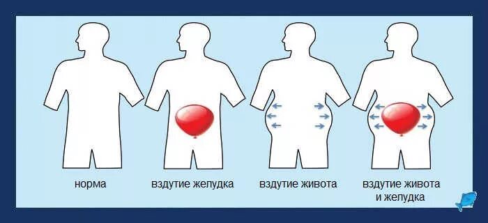 Вздутие желудка боли лечение. Вздутие кишечника и газообразование. Газообразование в животе. Вздутие живота желудка.