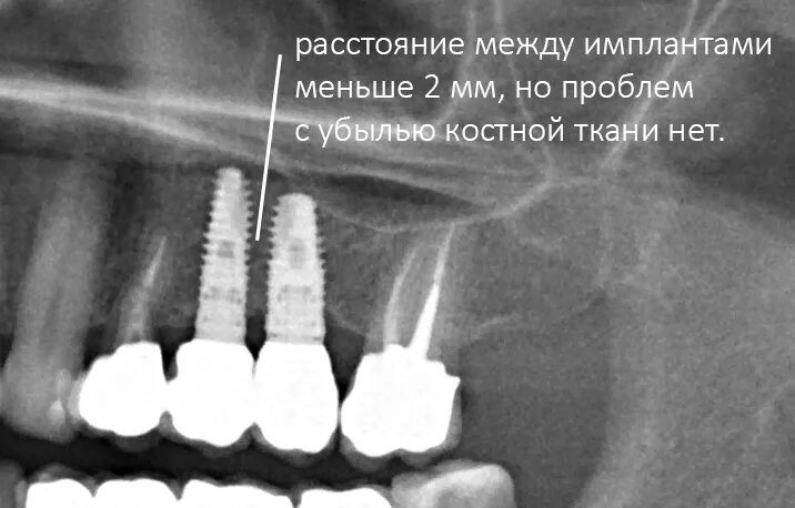 Какое расстояние между зубами. Расстояние между имплантом и зубом. Расстояние между имплантатами. Близкое расположение имплантата к зубу. Расстояние от зуба до импланта.