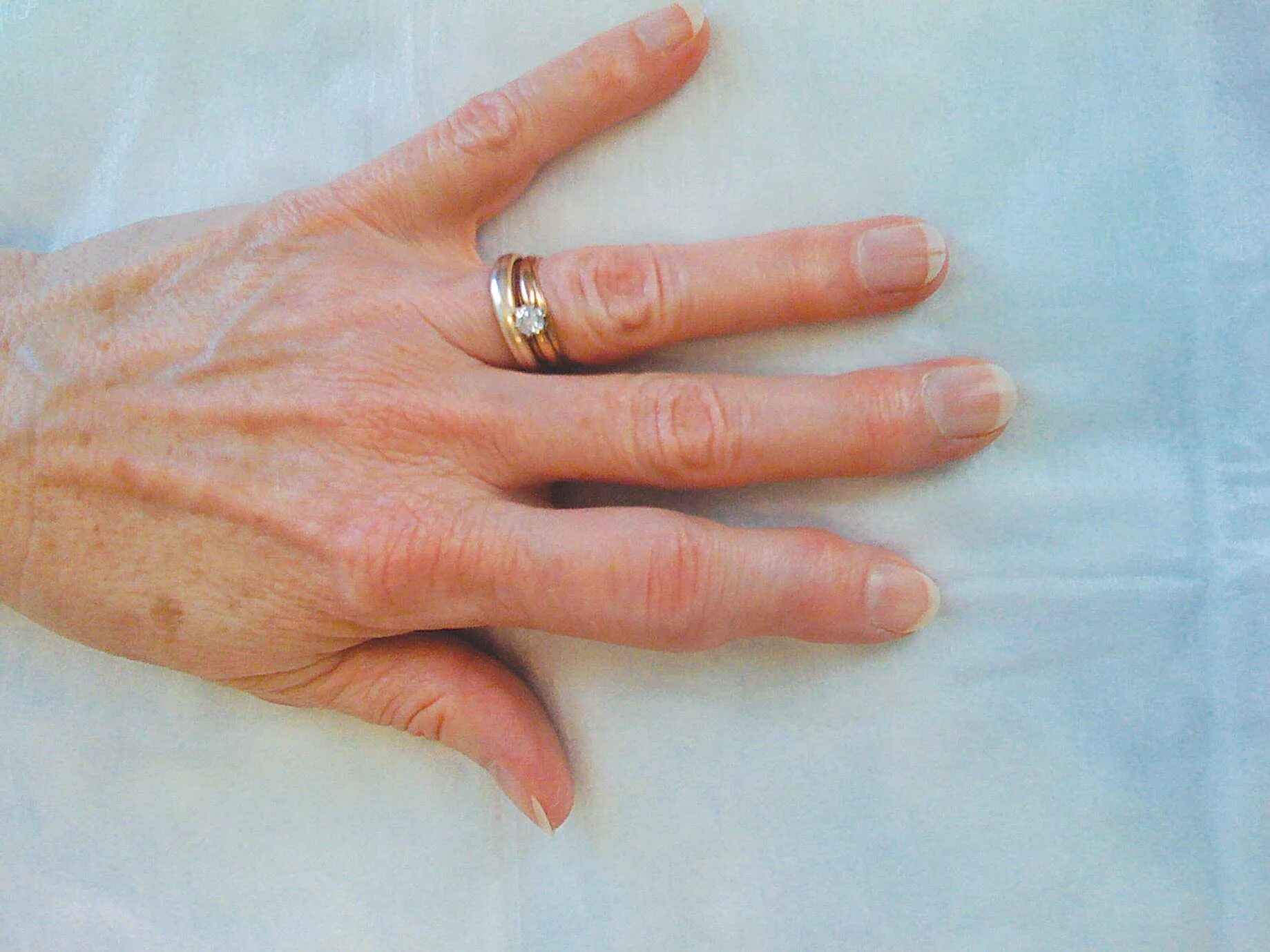 Больные пальцы рук. Псориазный ревматоидный артрит. Псориатический артрит кистей рук. Псориатический артрит пальцы. Ревматоидный артрит тофусы.