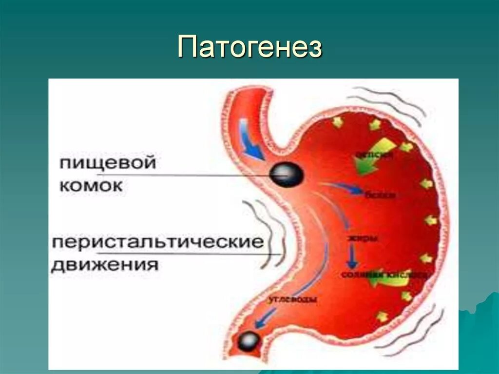 Патогенез хроническогогастирита. Патогенез хронического гастрита. Этиология гастрита. Этиология хронического гастрита. Роль гастрита