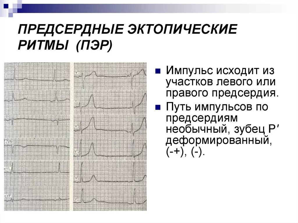 Эктопический предсердный ритм на ЭКГ. Эктопический предсердный ритм на ЭКГ У ребенка. Эктопический ритм сердца на ЭКГ. Эктопический нижнепредсердный ритм на ЭКГ. Эктопический предсердный ритм что это