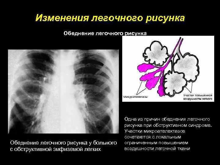 Синдром изменения легочного рисунка рентген. Изменение легочного рисунка. Патологические изменения легочного рисунка. Изменение легочного рисунка заболевания. Что означает изменения в легких