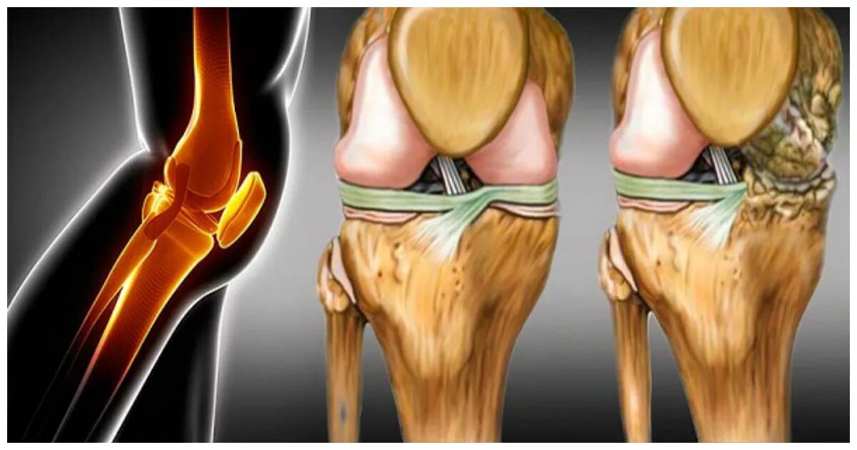 Хрящевая ткань коленного сустава. Абразивная хондропластика коленного сустава. Пателлофеморальный сустав. Артрит мениск коленного сустава. Что разрушает суставы