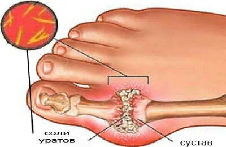 Заболевание суставов подагра. Почему болезнь королей