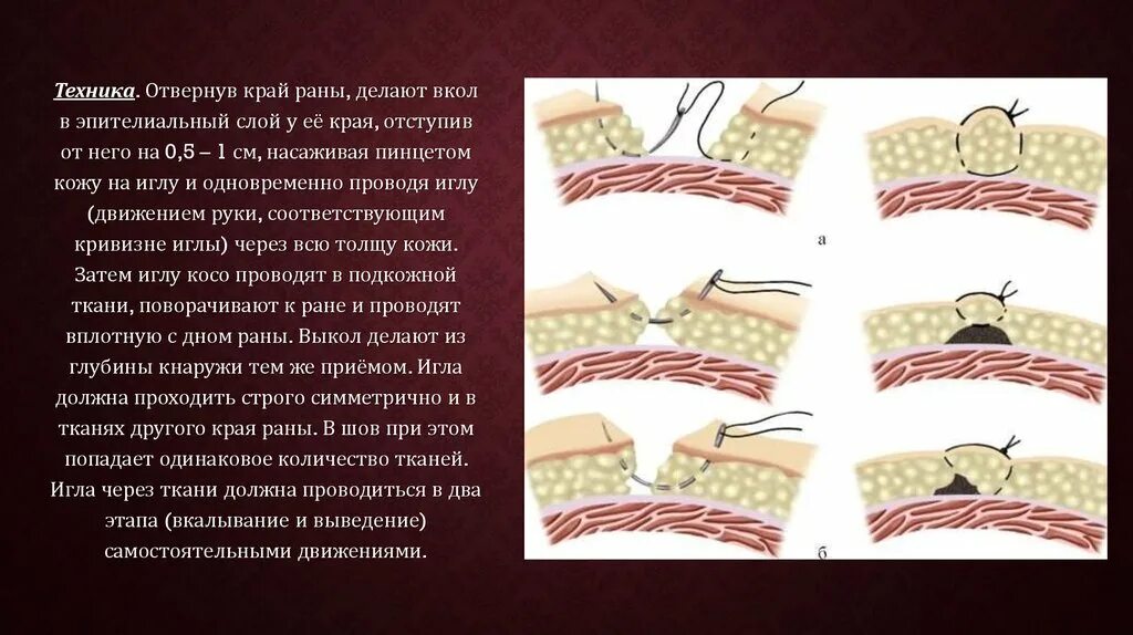 Сведение краев раны