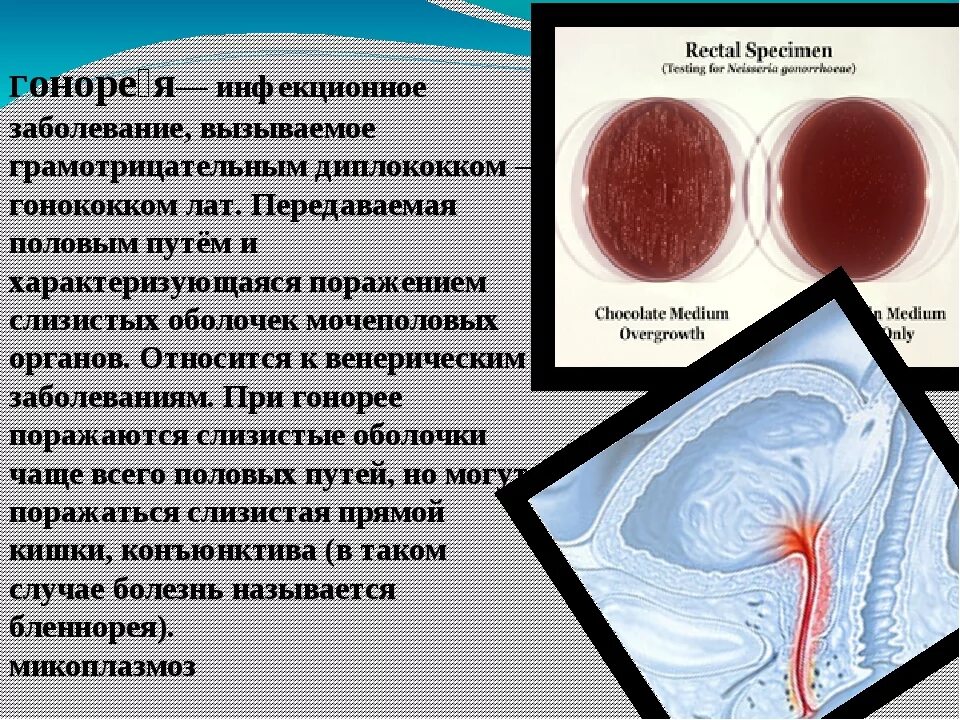 Цервицит что это у женщин причины. ИППП характеризуется поражением. Цервицит передается половым путем или нет.