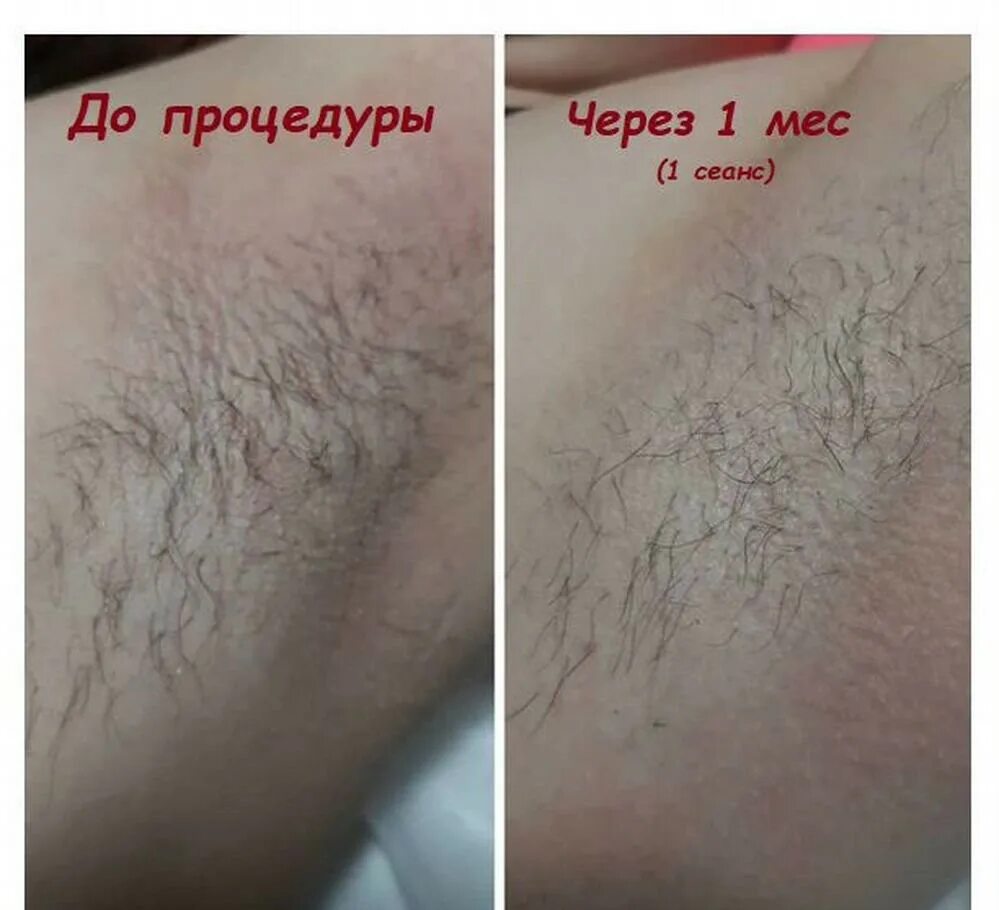 Фотоэпиляция зоны бикини. Сколько по времени электроэпиляция каждая зона. Волосяная луковица. Примерный расчёт времени на электожпиляцию по зонам. Электроэпиляция голени.