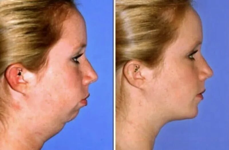 2 подбородок у худых. Второй подбородок у худых девушек. Второй подбородок у худых девушек. Второй подбородок. Второй подбородок у худых девочек.