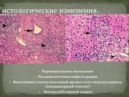 Хроническая дистрофия печени