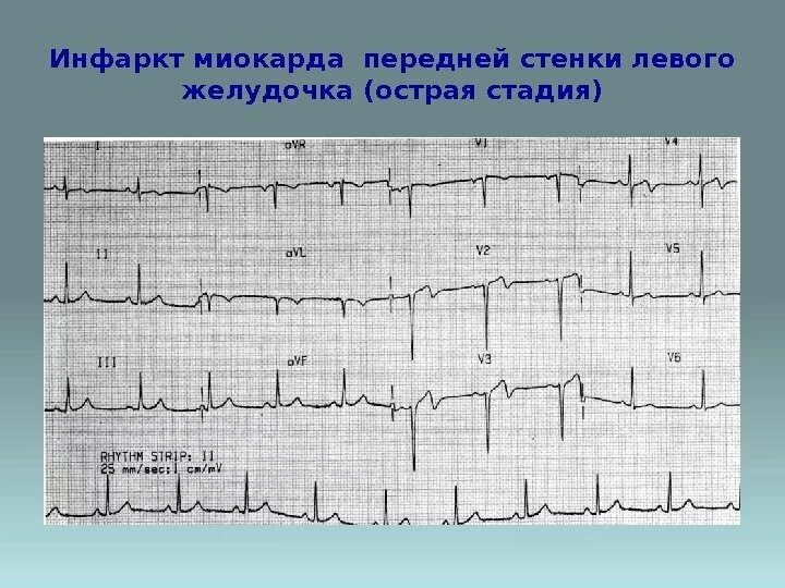 Инфаркт миокарда Нижне боковой стенки ЭКГ. Инфаркт миокарда передней стенки ЭКГ. Инфаркт миокарда передней стенки левого желудочка на ЭКГ. Мелкоочаговый инфаркт передней стенки.