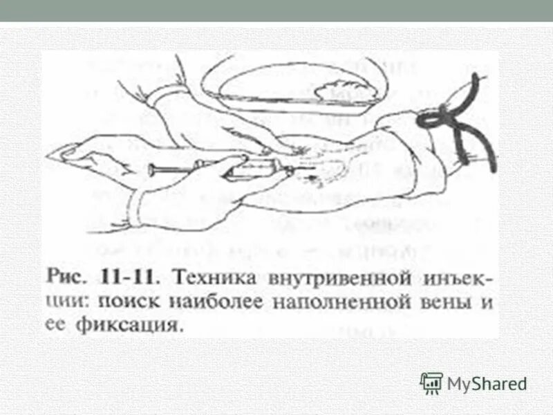 Внутривенное введение лекарственных средств алгоритм. Внутривенная инъекция техника выполнения. внутривенное введение алгоритм манипуляции. методика внутривенной инъекции. внутривенная инъекция схема.