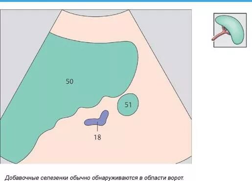 Добавочная долька селезенки на кт. Дополнительная селезенка. Дополнительная долька селезенки на кт. Дополнительная долька селезенки на УЗИ.