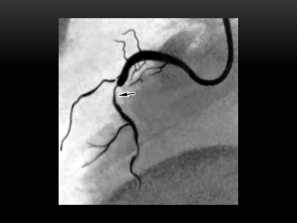 Сужение правой артерии. Коронарография стеноз. Инфаркт на коронарографии. Коронарография сердца стеноз.