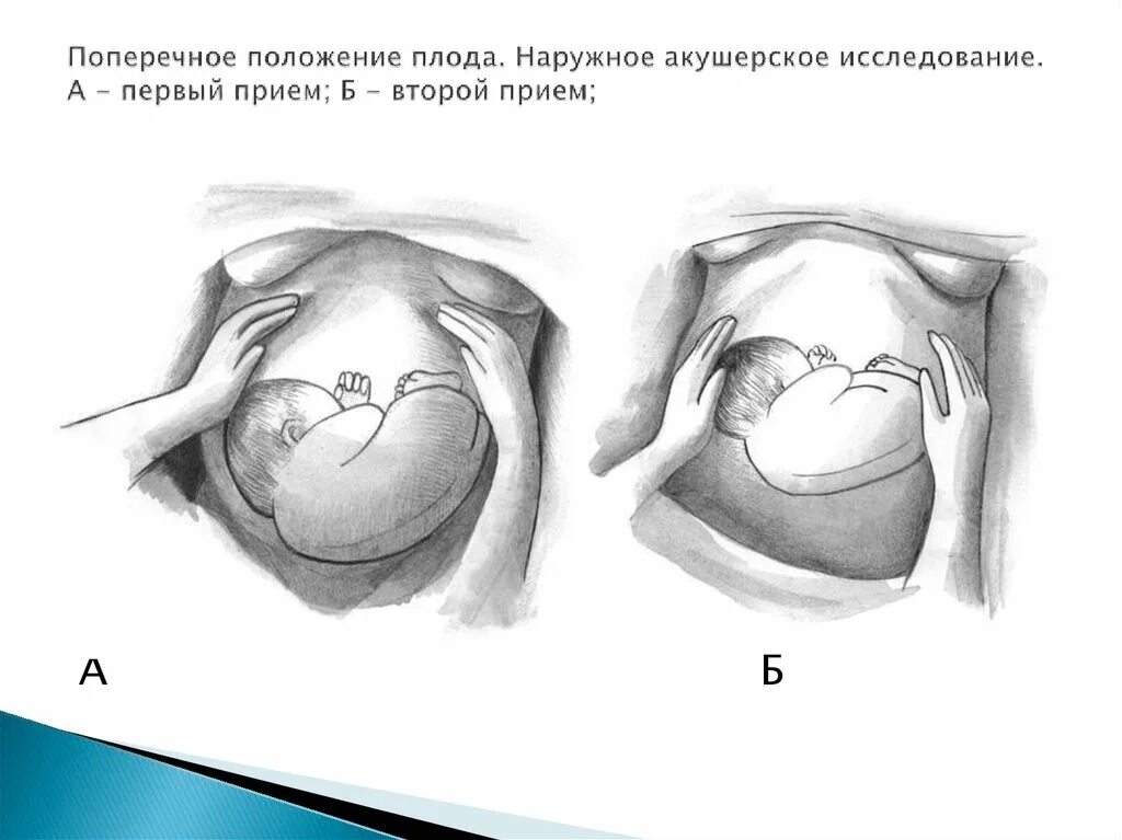 Горизонтальное предлежание плода. Поперечное расположение плода при беременности в 35 недель. Поперечное и косое положение плода. Поперечное предлежание плода. Запущенное положение плода