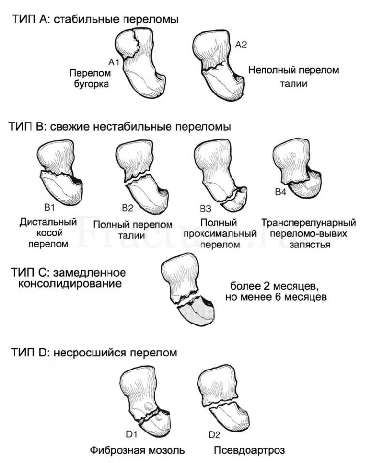 ложный сустав ладьевидной кости кисти. перелом ладьевидной кости рентген. ладьевидная кость перелом сколько. перелом ладьевидной кости рентген. ладьевидная кость кисти перелом.