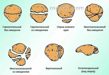 Перелом надколенника операции