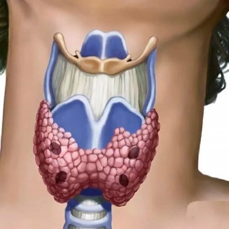 Зобная железа щитовидной железы. Эутиреоз щитовидной железы симптомы.
