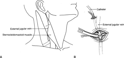 Catheterization of the Internal jugular Vein scheme. Catheterization jugular Vein of Pediatric. Internal pointing