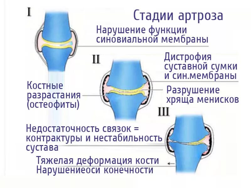 Степени артроза коленного сустава. Схема развития деформирующего остеоартроза. Несдавленный