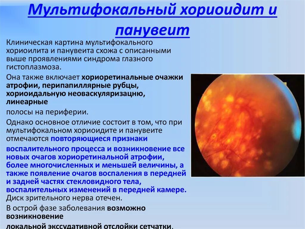 Заболевания сосудистой оболочки. Мультифокальный хориоретинит. Хориоретинит классификация. Клиническая картина хориоретинита. Заболевания хориоидеи.