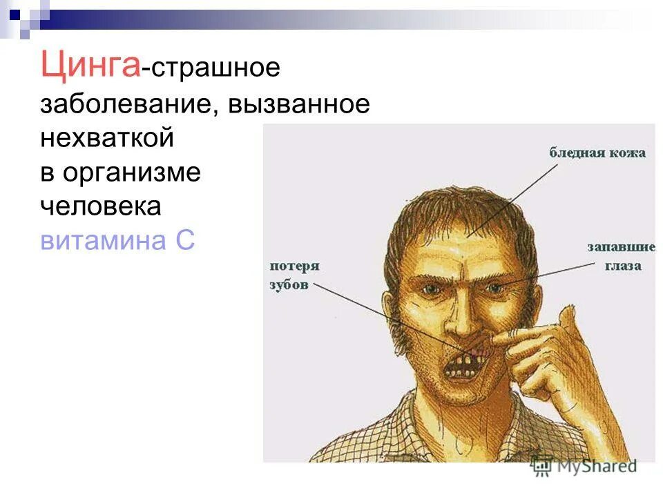 Ценга. Цинга вызывается недостаточностью витамина. Цынг.