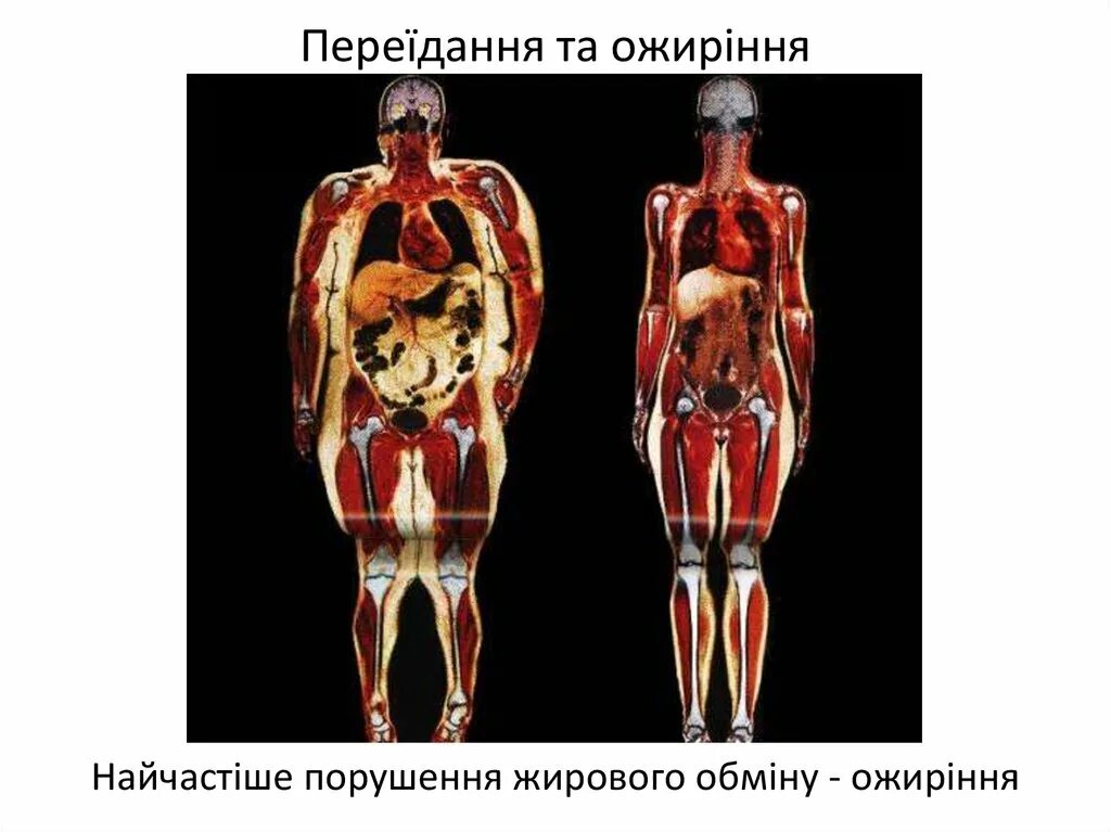 Рентген Толстого человека и худого. Скелет Толстого и худого человека. Скелет Толстого человека.