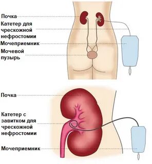 Катетер в почке