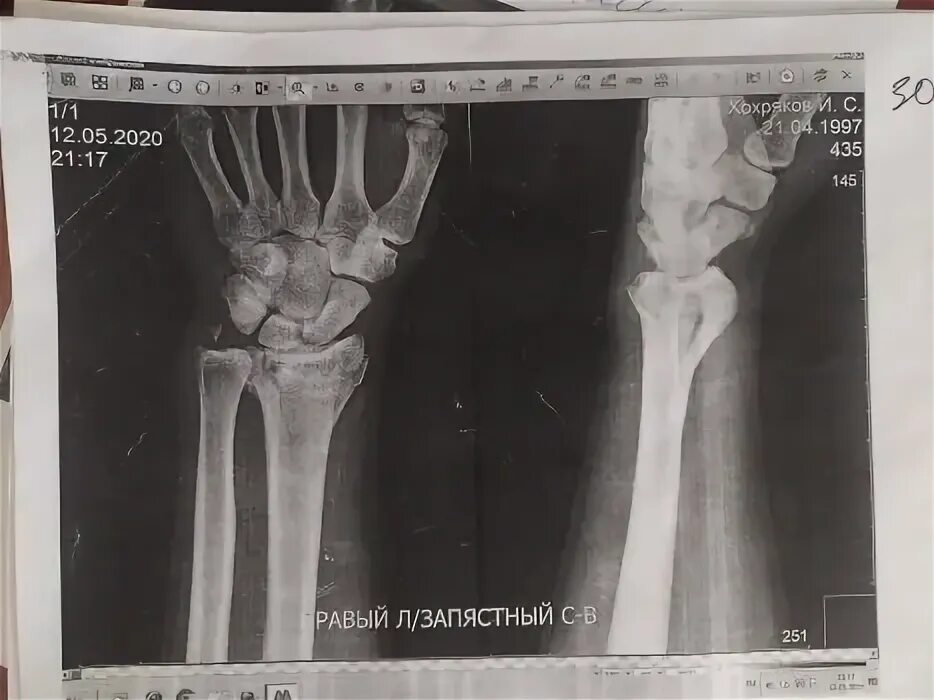 Перелом лучевой кости руки. Переломы головки и анатомической шейки плечевой кости. Репозиция при переломе луча в типичном месте. Репозиция лодыжек закрытая. Как вправляют перелом со смещением.