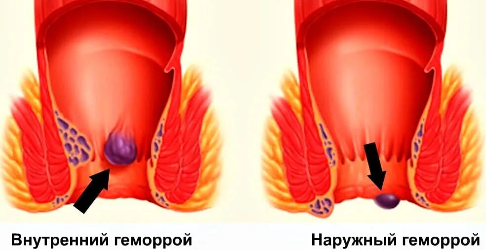 Анальное отверстие геморрой. Тромбированный геморрой. Внешний геморроидальный узел. Боли внутри заднего прохода