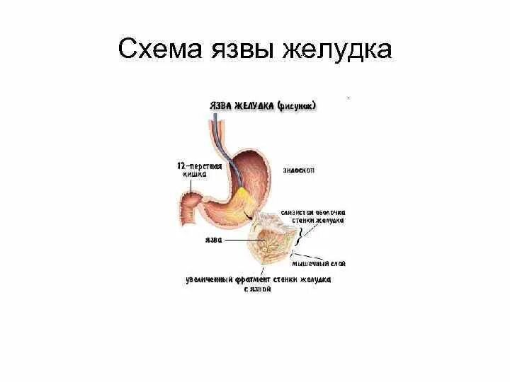 Язва 2 типа. Язвенная болезнь желудка и 12 перстной. Язва желудка и 12 перстной кишки. Язвенная болезнь желудка.12 перстной кишки локализация.