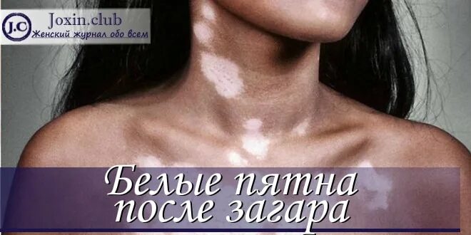 Как избавиться от красноты после загара. Светлые пятна на коже после загара. белые пигментные пятна после загара. светлые пятна на теле после загара. белые пятна на коже после загара.