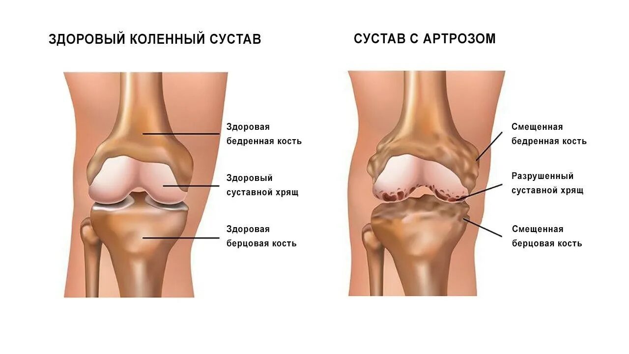 Что такое сустава в суставах. Здоровый коленный сустав. здоровый хрящ коленного сустава. разрушение хряща и костей коленного сустава. остеоартрит коленного сустава.