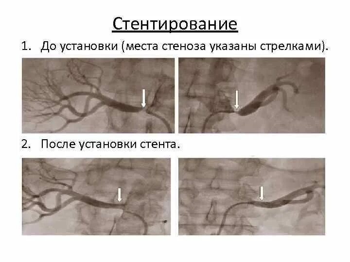 Стент общего желчного протока. Стентирование общего желчного протока. Стентирование желчных протоков. Эндопротезирование желчных протоков (стентирование). Стент желчного протока