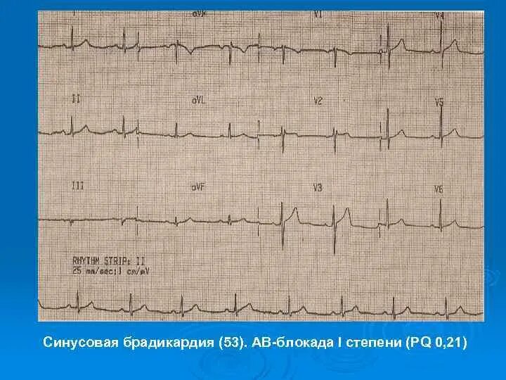 Блокада экстрасистолы. Ав блокада с экстрасистолой. Желудочковая экстрасистолия по типу блокады правой ножки пучка. Левожелудочковая экстрасистолия на экг. Атриовентрикулярная блокада 2 ст.