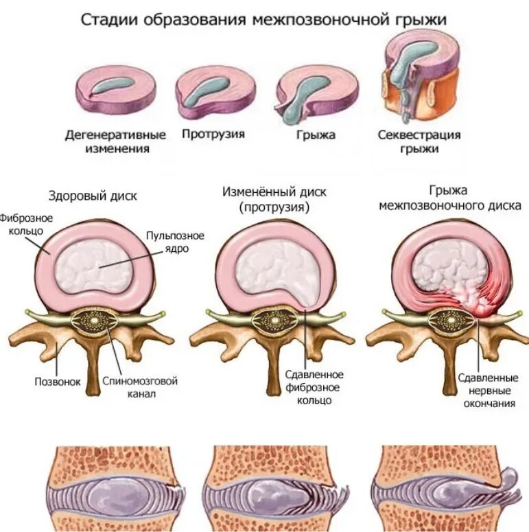 Медианно парамедианная билатеральная. Этапы формирования грыжи позвоночника. Этапы формирования грыжи межпозвоночного диска. Межпозвоночная грыжа пульпозное ядро. Стадии формирования грыжи диска.