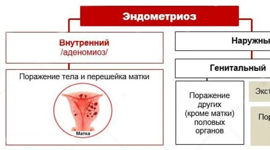 Народное лечение эндометриоза матки. Наружный генитальный эндометриоз классификация. Внутренний и наружный генитальный эндометриоз. Классификация внутреннего эндометриоза. Внутренний эндометриоз аденомиоз матки.