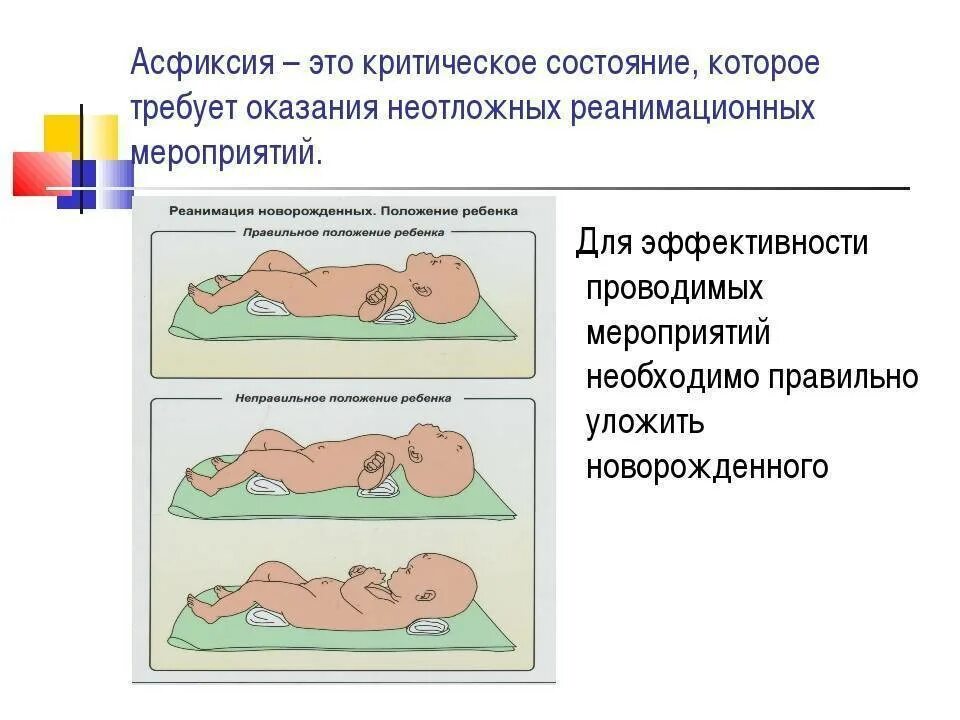 Асфиксия у детей педиатрия. Асфиксия новорожденного реанимация. Этапы реанимации новорожденного. Положение новорожденного при асфиксии.