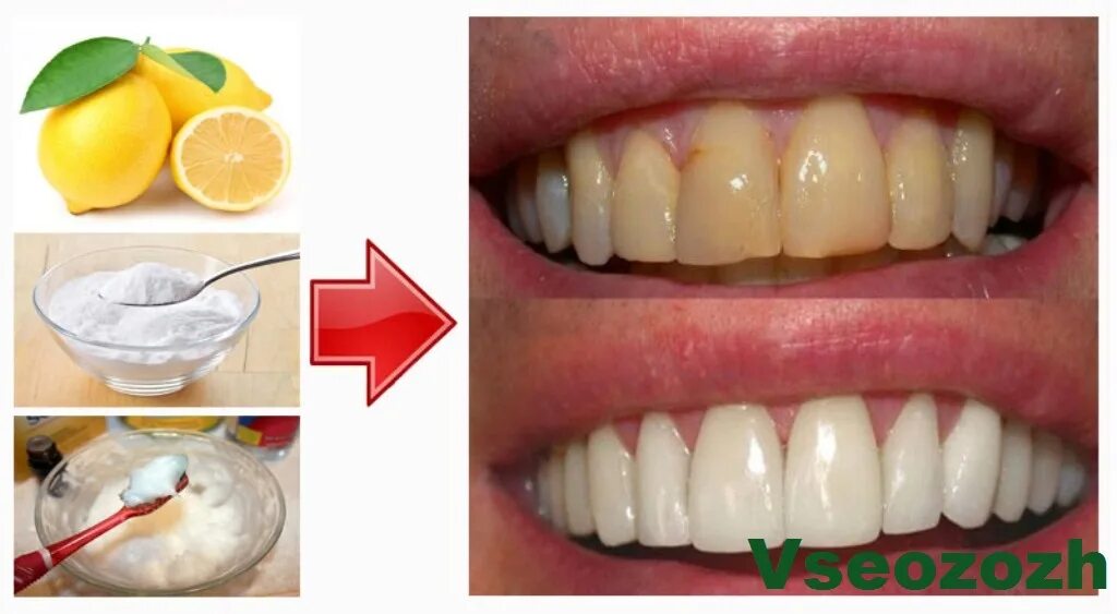 Отбеливание зубов содой. Отбелевание Зублов в домаш. Домашнее отбеливание зубов. Что кушать после чистки зубов