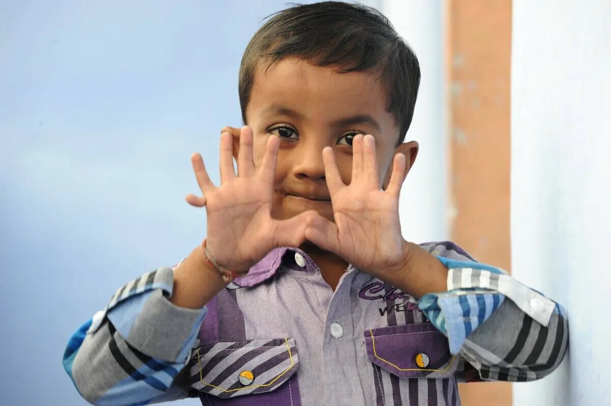Полидактилия Акшат Саксена. Дети с шестью пальцами. Сколько лет пальцами