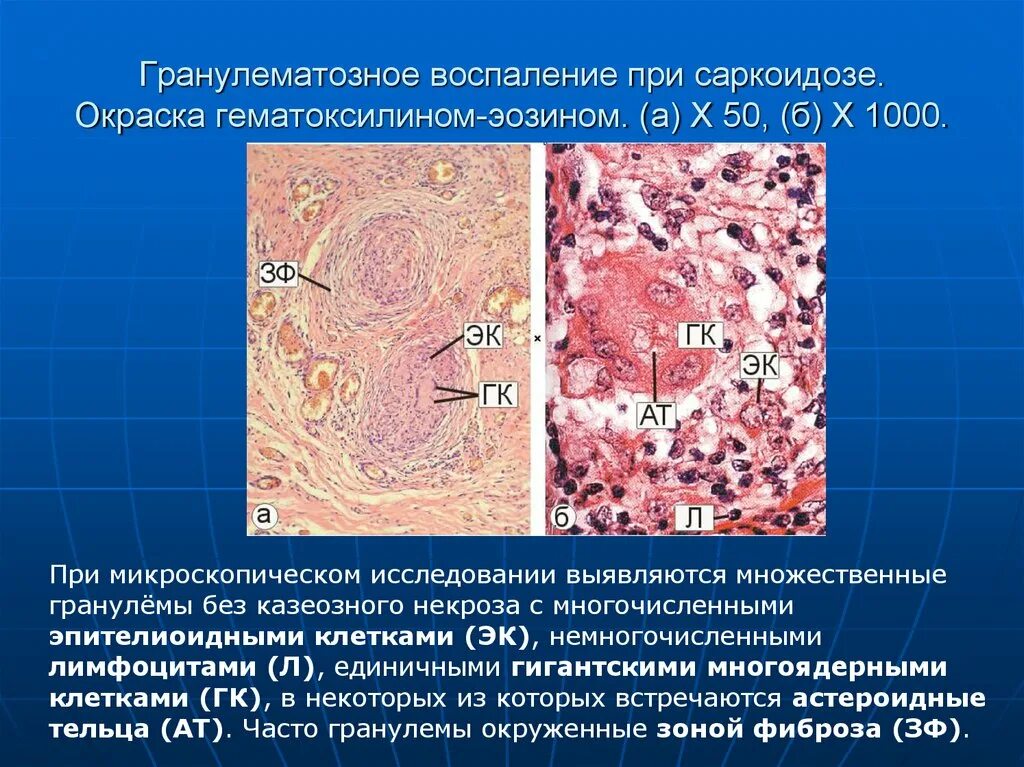 Саркоидоз лимфатических узлов. Саркоидоз патологическая анатомия. Абсцедирующая гранулёма. Туберкулезной гранулемы патанатомия макропрепарат. Саркоидная гранулема