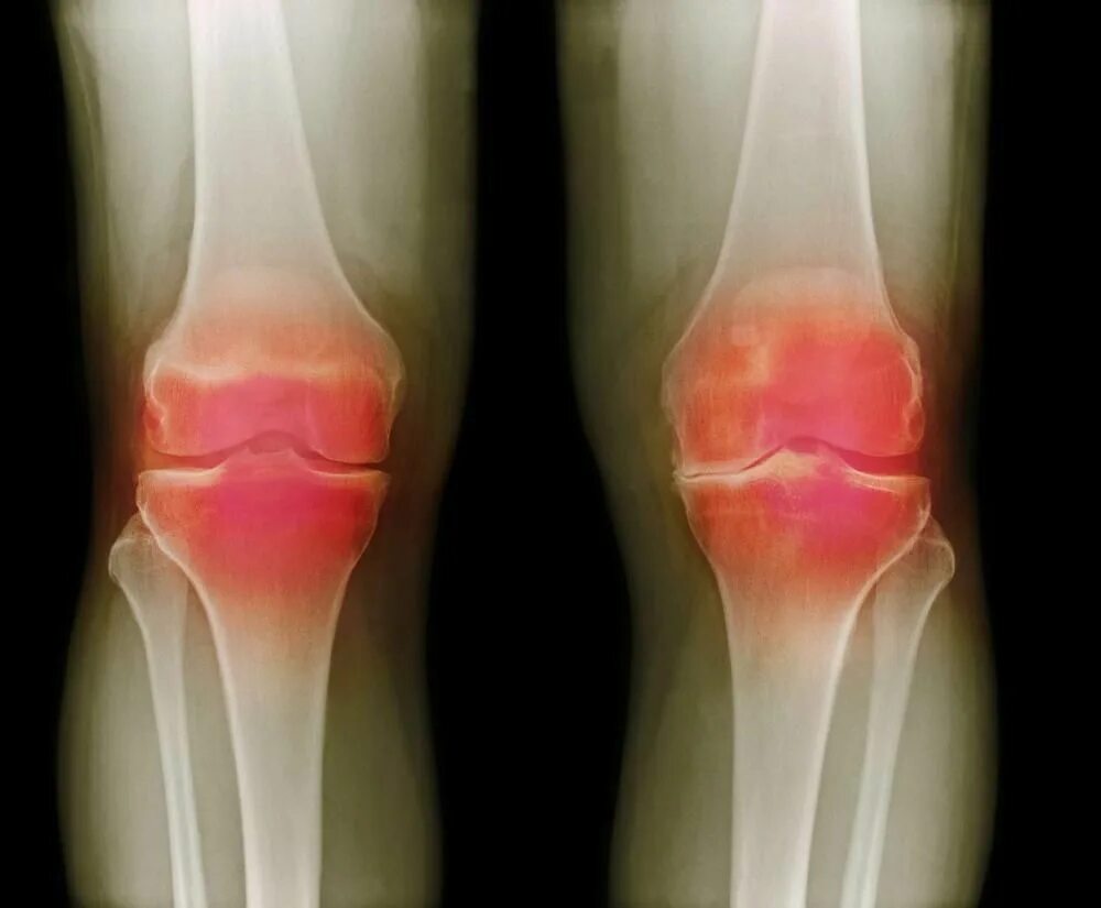 Ревматоидный артрит коленного сустава рентген. Лигаментоз крестовидных связок коленного сустава что это. Ревматический артрит коленного сустава. Подагра коленного сустава рентген.