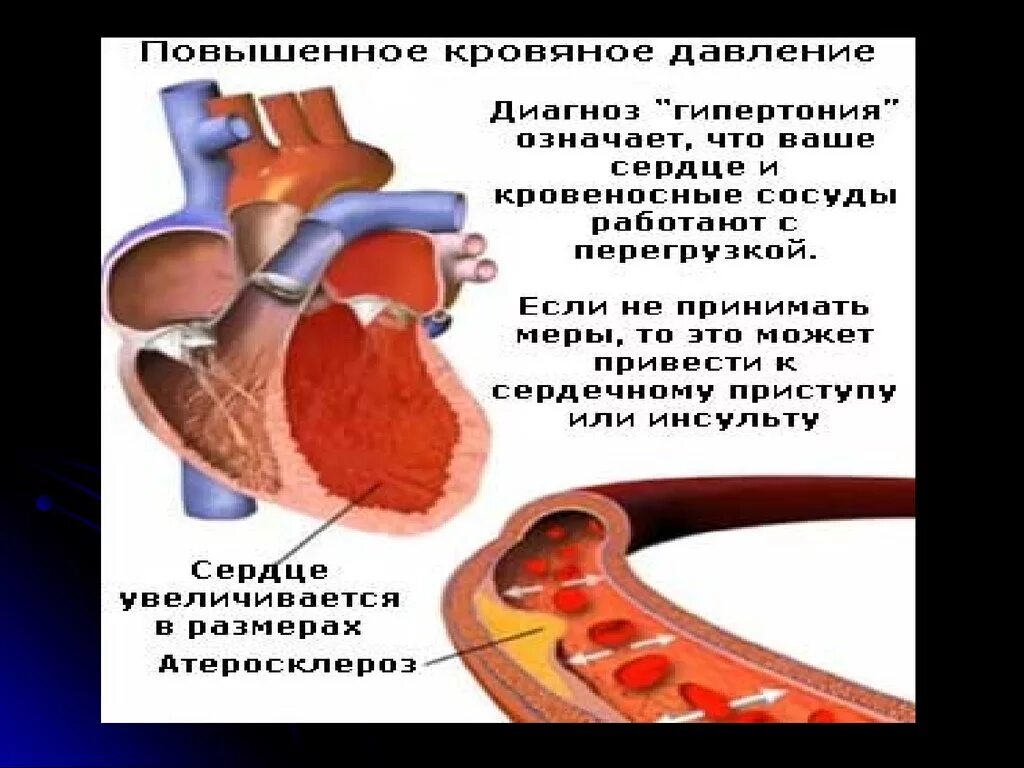 Гипертоническая болезнь и армия. Давление диагноз. Повышение давления диагноз. Диагноз давление какой. Диагноз давления как называется.