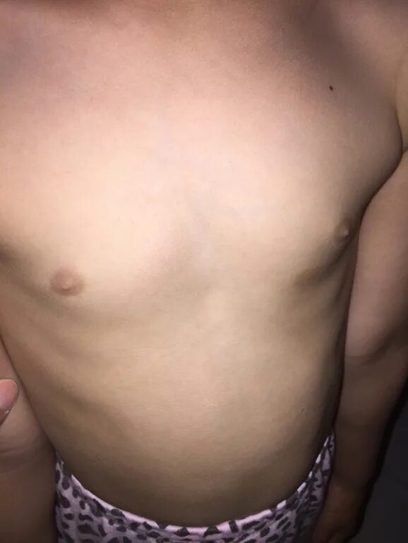 гнойный мастит новорожденных. мастоопатияу новорожденных. половой криз у новорожденного. юношеская гинекомастия. рост груди.