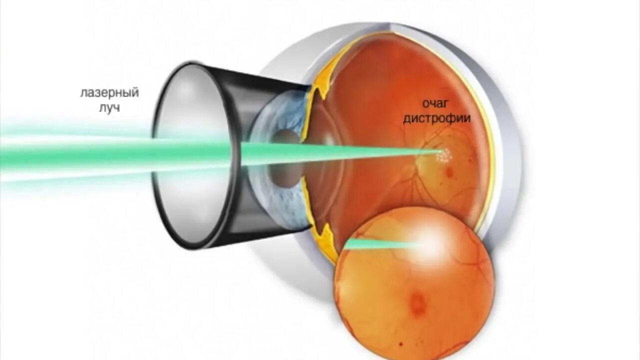 Лазерная коагуляция сетчатки. Воздействие на глаз лазером. Линза для лазерной коагуляции. Лазерные коагуляты на сетчатке.